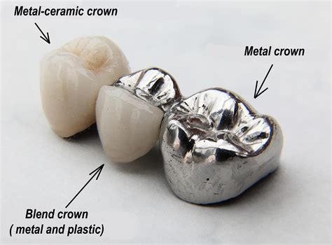 fabrication of metal ceramic crown|metal ceramic crowns vs all.